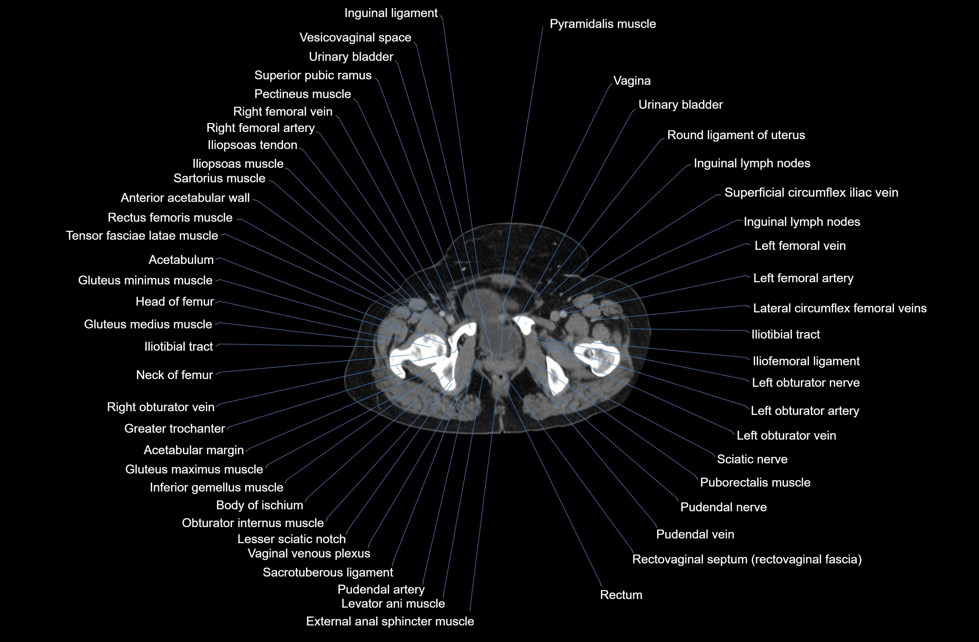 CT Abdomen axial cross sectional anatomy labelled radiology image-00096.webp